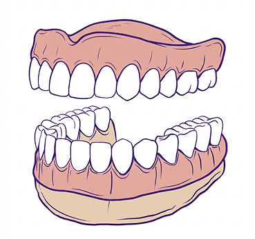 Implant-Supported Dentures