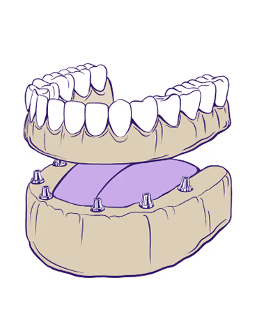 Full-Mouth Dental Implants