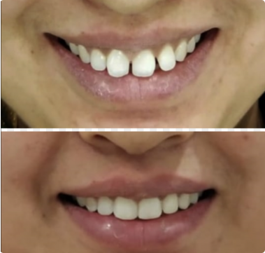 teeth gap before & after invisible aligners