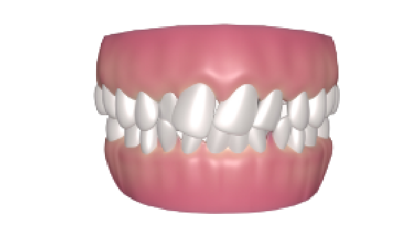 crowded teeth condition