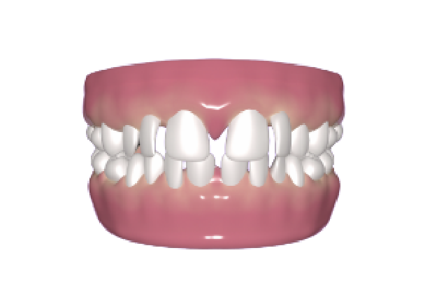 teeth gap condition