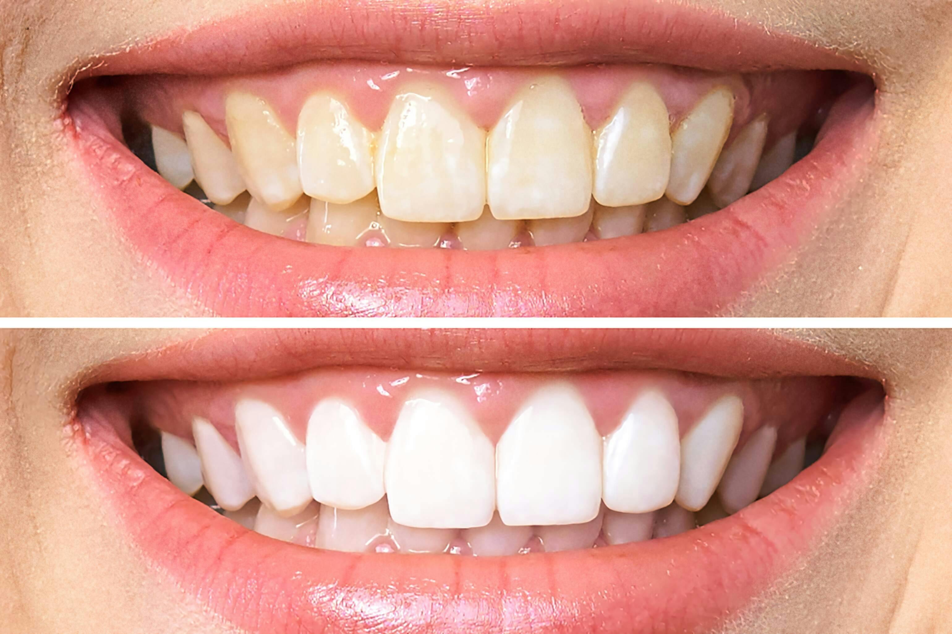 before and after teeth whitening picture