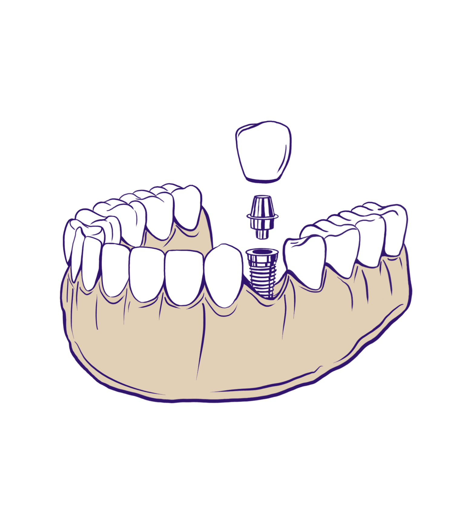 Dental implants